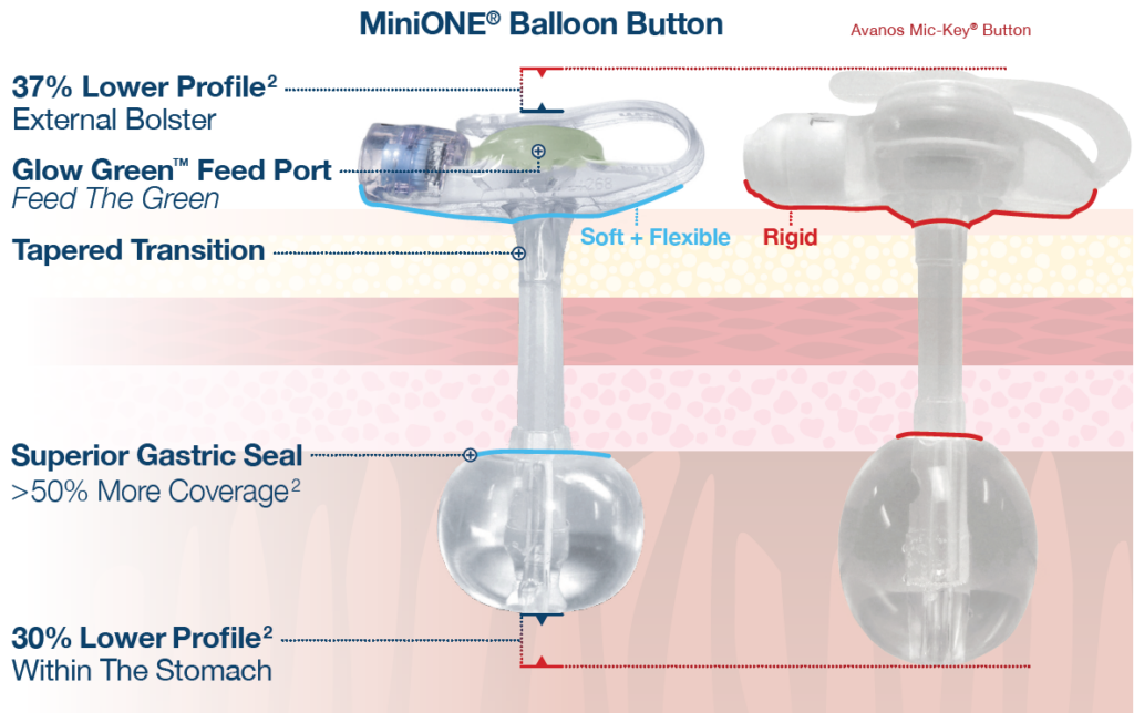 AMT MiniONE Balloon Button Low Profile 16F 1.5cm PEG Feeding Tube, Each